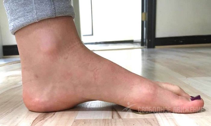 Поперечное плоскостопие стопы ног: симптомы и лечение у взрослых и ...