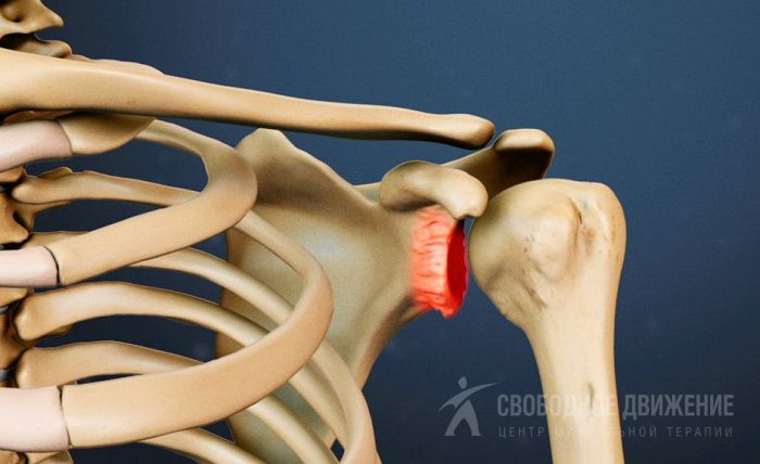 Деформирующий остеоартроз плечевого сустава: причины и симптомы ...