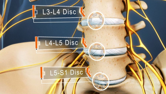 Протрузия дисков фото