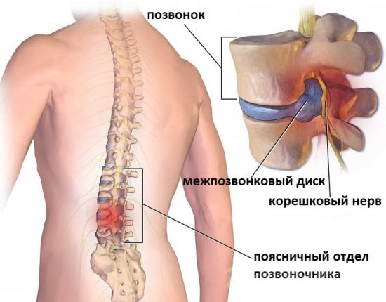 Циркулярная протрузия и грыжа диска