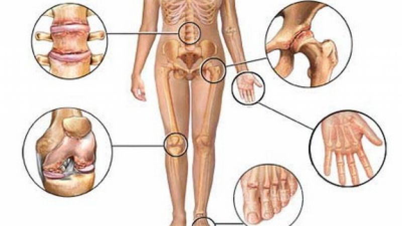 Как вылечить остеоартроз всех суставов thumbnail