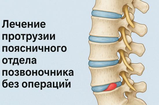 Лечение протрузии поясничного отдела позвоночника без операций и медикаментов