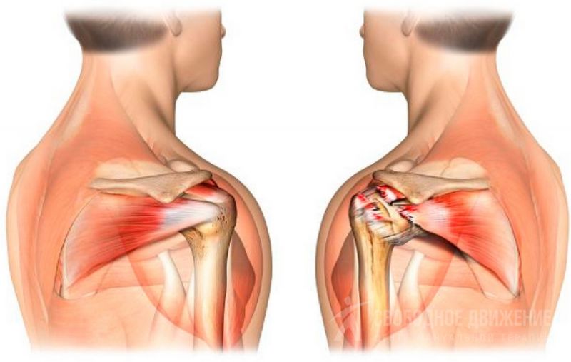 Почему не болят мышцы плеч thumbnail